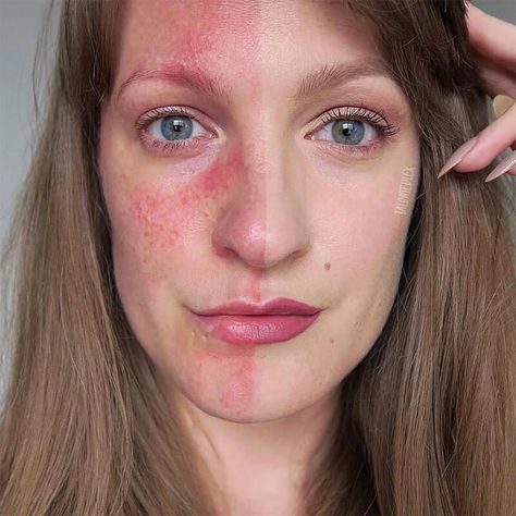 Rosacea and make up - how it can help, why it's important to some people, and tips for using make up to cover rosacea. Rosacea make up tips.  #talontedlex #rosaceaadvice #rosaceatips Skin Positivity, Haut Routine, Real Skin, Skin Dryness, Skin Routine, Pure Beauty, Skin Conditions, Beautiful Skin, Skin Treatments