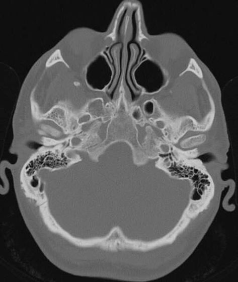 Ear Canal, X Rays, Ct Scan, Medical Imaging, Radiology, Head And Neck, X Ray, Anatomy, Bones