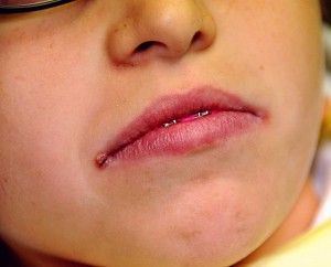 Signs of angular cheilitis will nearly appear at the edges of the mouth. Find out more about cracks corners of mouth diagnosis and its treatments. #angularcheilitisremedyessentialoils Cracked Corners Of Mouth, Crusty Skin, Angular Cheilitis, Sore Lips, Natural Aloe Vera, Cracked Lips, Cracked Skin, Skin Disorders, My Mouth