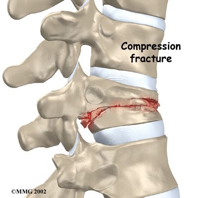 Symptoms of a Spinal Compression Fracture http://www.webmd.com/osteoporosis/guide/spinal-compression-fractures-symptoms Spine Bone, Fracture Healing, Chiropractic Therapy, Radiology Student, Spine Care, Severe Back Pain, Medical Transcription, Bone Fracture, Spinal Injury