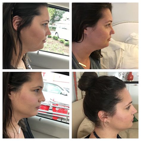 Belkyra Before And After, Kybella Before And After Double Chin, Kybella Before And After, Girl Emoji, Botox Fillers, Intelligent Women, Cosmetic Treatments, Gobble Gobble, Cosmetic Procedures