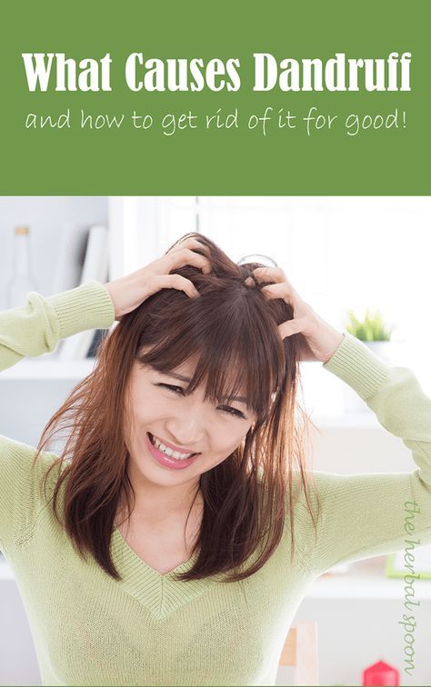 How to get rid of dandruff for good and what causes dandruff - The Herbal Spoon How To Reduce Dandruff Naturally, How To Reduce Dandruff, What Causes Dandruff, How To Remove Dandruff, Reduce Dandruff, Rid Of Dandruff, Natural Remedies For Migraines, Getting Rid Of Dandruff, Coconut Oil Hair Mask