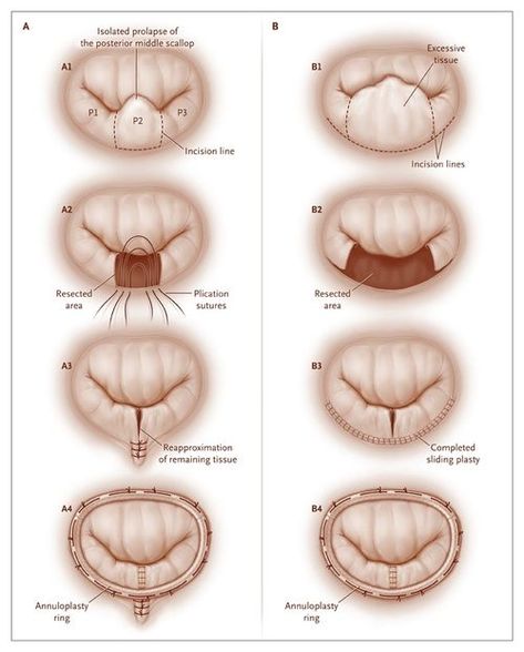 Mitral Valve Regurgitation, Heart Facts, Heart Valve, Diagnostic Medical Sonography, Heart Surgeon, Mitral Valve, Chest Discomfort, Heart Valves, Medical Pictures