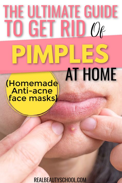 7 Easy DIY Face Masks For Acne Clear Face Tips, Anti Acne Face Mask, Pimple Mask, Face Mask For Pimples, Face Masks For Acne, Anti Acne Mask, Masks For Acne, How To Clear Pimples, Home Remedies For Pimples