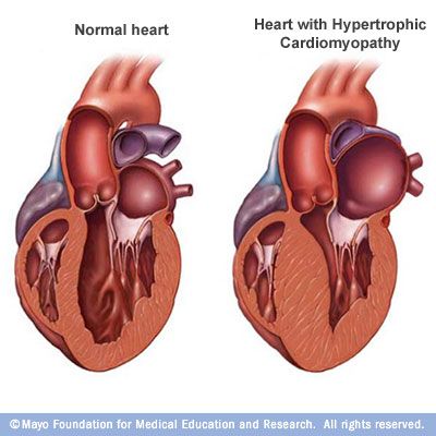 A normal heart (left) and a heart with hypertrophic cardiomyopathy (HCM). Note that the heart walls (muscle) are much thicker (hypertrophied) in the #HCM heart. Chd Awareness, Normal Heart, Cardiac Nursing, Congenital Heart Defect, School Studying, Heart Defect, Heart Care, Congenital Heart, Heart Muscle