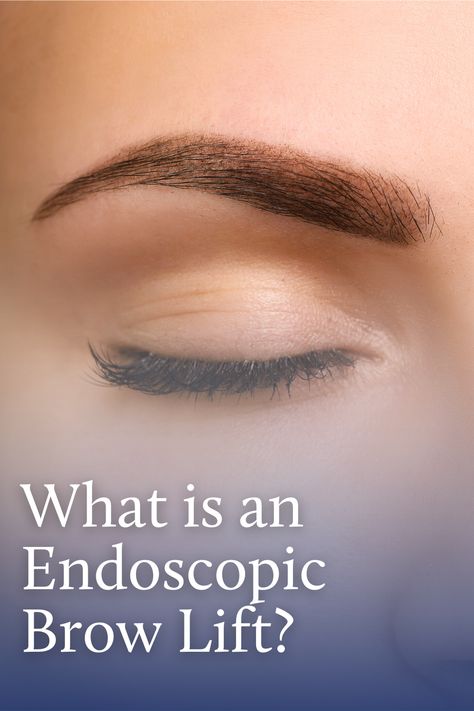 Aging is inevitable and leads to wrinkles, which can affect the look of a person. Those who would like to restore their youthful and attractive appearance may want to undergo treatments to reduce the effects of aging. Brow lifts helps in lifting skin that is sagging and smooths it out, thereby getting rid of wrinkles and raising the eyebrows. Learn more about endoscopic brow lifts. Endoscopic Brow Lift Before And After, Eyebrow Lift Surgery, Eye Brow Lift, Brow Wrinkles, Endoscopic Brow Lift, Brow Lift Surgery, Eyebrow Lift, Eyelid Lift, Excess Skin