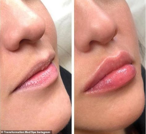 Lip 'threading' is the trend tipped to take over fillers: How nova threads work Lip Tattoo Ideas, Lips Reference, Balzam Na Pery, Lips Aesthetic, Lips Illustration, Lip Plumping Balm, Lips Inspiration, Draw Lips, Permanente Make-up