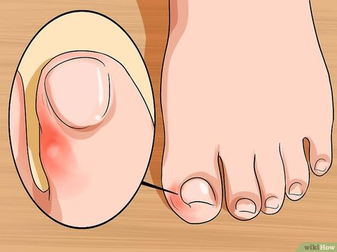 5 Ways to Relieve Ingrown Toe Nail Pain - wikiHow Toenail Pain, Nail Infection, Nail Fungus Remedy, Ingrown Toenail, Nail Soak, Ingrown Nail, Matte Nail Polish, Brittle Nails, Ingrown Toe Nail