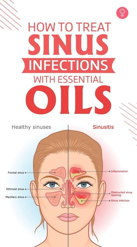 Treat Sinus Infection, Herbal Sinus Remedies, How To Get Over A Sinus Infection Fast, Treating Sinus Infection Naturally, Natural Remedies For Sinus Pressure, Treat Sinus Infection Naturally, Home Remedy For Sinus Drainage, Chronic Sinus Infection, Heal Sinus Infection Naturally