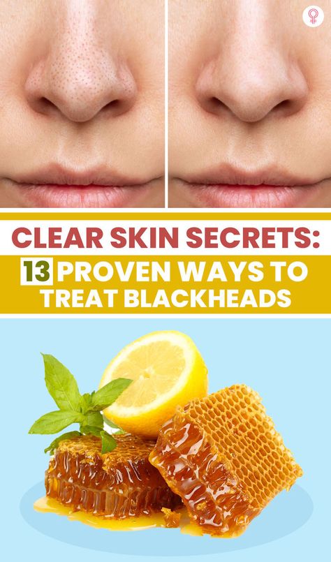 Honey Skin Care, Remove Blackheads From Nose, Blackheads On Nose, Autumn Skincare, Skin Care Business, Rid Of Blackheads, Facial Steaming, Blackhead Removal, Get Rid Of Blackheads