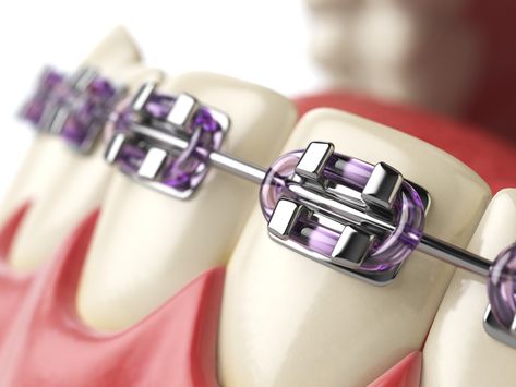 Ceramic Braces, Human Mouth, Esthetic Dentistry, Tooth Infection, Dental Posters, Aesthetic Dentistry, Braces Colors, Dental Braces, Teeth Braces