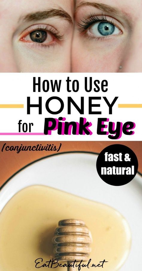 Honey is the fastest and most effective remedy I've used for pinkeye. This post shares with you how to use it, why it works and some other natural approaches. | Eat Beautiful || #pinkeye #honey #DIY #remedy Treating Pink Eye, Pink Eye Home Remedies, Natural Pink Eye Remedy, Honey Health Benefits, Pinkeye Remedies, Eat Beautiful, Pink Eye, Natural Cough Remedies, Holistic Remedies