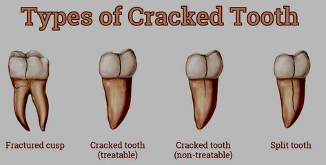 Cracked Tooth Syndrome | Lorne Park Dental | Mississauga Dentist Fca Ideas, Tooth Nerve, Cracked Tooth, Tooth Filling, Molar Tooth, Dental Fillings, Front Teeth, Tooth Enamel, Dental Veneers