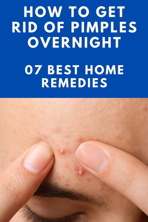 Face Pimples Remedies, Zit Remedy, Remove Pimples Overnight, Natural Remedies For Pimples, Get Rid Of Pimples Overnight, Rid Of Pimples Overnight, How To Cure Pimples, Blind Pimple, Home Remedies For Pimples