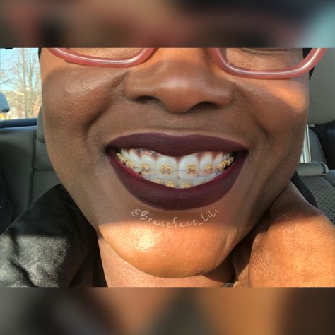 Gold Braces, dark Lipstick on dark skin Lipstick On Dark Skin, Fake Braces, Jewelry Teeth, Braces Colors Ideas, Gold Braces, Teeth Gems, Cute Braces Colors, Braces Cost, Adult Braces