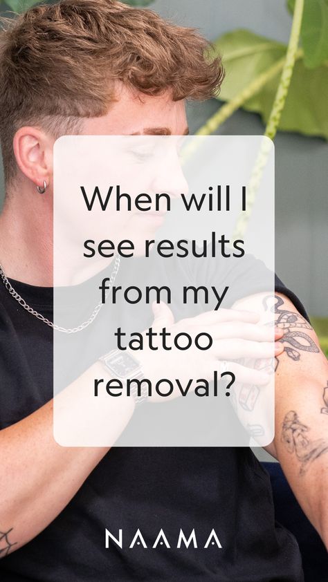 Tattoo removal is a process. It takes 8-12 sessions (on average) to fully clear a tattoo - but how long does it take to start seeing results? We explain what you can expect when removing a tattoo. Laser Tattoo Removal Process, At Home Tattoo Removal, Picosure Tattoo Removal, See Tattoo, Laser Tattoo, Laser Tattoo Removal, Tattoo Removal, Support Group, A Tattoo