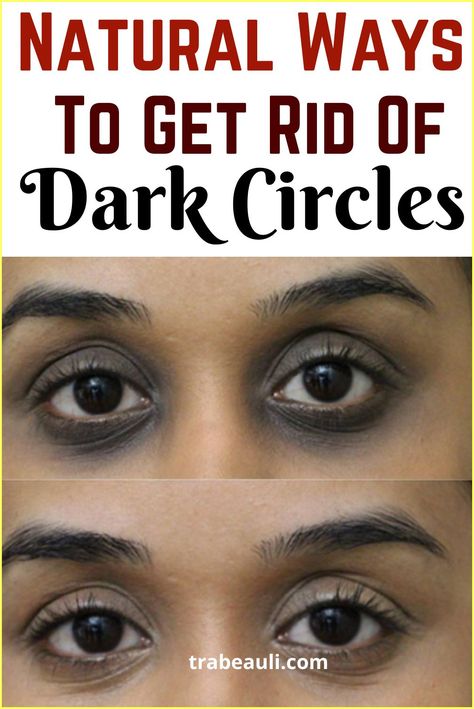 Dark Rings Under Eyes, Darkcircles Skincare, Dark Spots Under Eyes, Dark Circle Remedies, Dark Circles Around Eyes, Hooded Eyelids, Dark Eye Circles, Reduce Dark Circles, Dark Circles Under Eyes