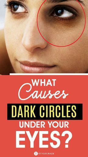 How to Remove Dark Circles with Vaseline Naturally in 3 Days (100% Results) Dark Rings Under Eyes, Causes Of Dark Circles, Best Under Eye Cream, Baggy Eyes, Dark Circles Around Eyes, Dark Rings, Aloe Vera Face Mask, Dark Eye Circles, Beauty Tips And Tricks