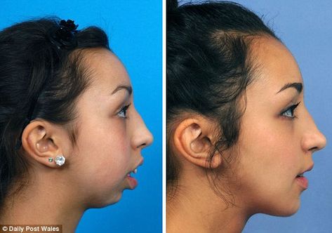 Before and after pictures reveal incredible transformation of woman after surgery Braces Transformation, Orthognathic Surgery, Maxillofacial Surgery, Plastic Surgery Fail, Plastic Surgery Gone Wrong, Face Surgery, Silicone Implants, Jaw Surgery, Dental Fun