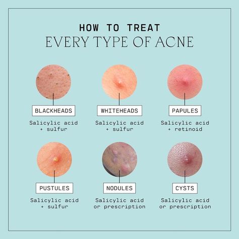 From blackheads to cysts, breakouts happen to pretty much everyone.🗣️ Say it with us: Acne is normal! Here's a handy guide on how to treat every type of acne. Save this for later and click to read The Good Skin Blog for a detailed breakout down. Skin Facts, Skin Advice, Natural Face Skin Care, Natural Acne Remedies, Types Of Acne, Skin Care Tutorial, Basic Skin Care Routine, Acne Scar Removal, Facial Skin Care Routine