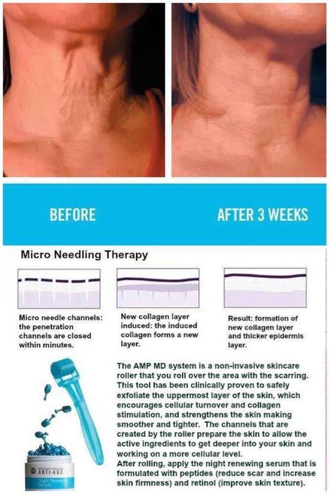 Acne Scar Remedies, Scar Remedies, Skin Needling, Micro Needling, Acne Causes, Derma Roller, Acne Remedies, Skin Care Remedies, Face Massage