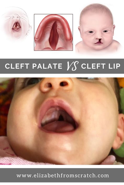 July is Cleft and Craniofacial Awareness Month! Did you know that about 1 out of every 700 babies is born with a facial cleft?  Many people assume cleft palate and cleft lip are the same thing. However, they are very different! Check out this post to learn more about these two birth defects. Oral Pathology, Cleft Lip And Palate, Cleft Palate, Cleft Lip, List Of Questions, Body Tissues, Upper Lip, The Roof, Just The Way