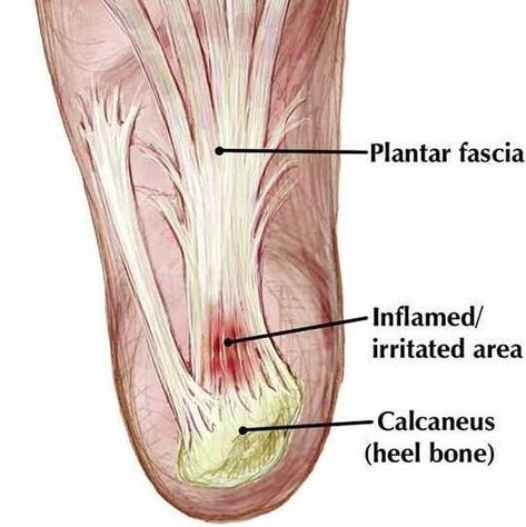 F&F | Foot Pain Solutions en Instagram: “WHAT is Plantar Fasciitis?⁠ ⁠ Plantar Fascia is a thick band of tissue that is jointed between the heel bone to the rest of the foot.…” Plantar Fascia Relief, Facitis Plantar, Foot Pain Relief Remedies, Plantar Fascitis, Heel Spur, Plantar Fascia, Heel Pain Relief, Pain Relief Remedies, Foot Exercises