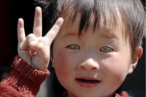 Nong Youhui, a little boy from Southern China, was born with a rare disease many refer to as “cat-eye.” With this condition, he is able to see in the dark just as well as he does during the daytime. According to reports, the boy’s eyes seem to glow at night due to the condition. The condition is known today as “Leukoderma.” The only sad thing is that his kind of eyes are extra sensitive to the light. Cat Eye Syndrome, Bowie Eyes, Hair Whorl, Fancy Mouse, Different Colored Eyes, Dark Complexion, Genetic Disorders, White Face, Genetic