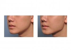 Jaw Angle, Facial Plastic, Plastic Surgery, Surgery, Facial, Google Search, Beauty