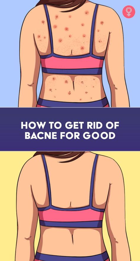 How To Get Rid Of Bacne For Good: That’s right, while acne ravages your face, bacne converts your smooth back into its pockmarked territory. The other drawback of having bacne is also that you never get to showcase your beautiful back in those beautiful sundresses. Now, that would be a shame, wouldn’t it? Backne Remedies Products, Backne Remedies Fast, How To Clear Back Acne, How To Get Rid Of Back Acne, Backne Remedies, Remedies For Back Acne, Acne Scab, Summer Perfumes For Women, Best Summer Perfumes