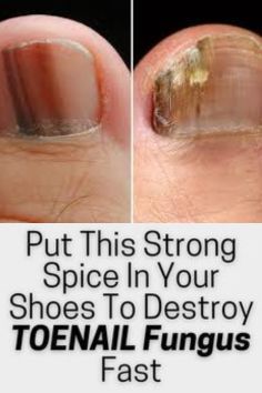 This homemade recipe is used to remove toenail fungus at home in one week#fungusproblem #killsnail #treatmentfungus #nailfungus #toenailfungus Toenail Fungal Infection, Nail Discoloration, Nail Remedies, Nails Feet, Toenail Fungus Remedies, Brown Nail, Nail Fungus Remedy, Nail Infection, Homemade Oil