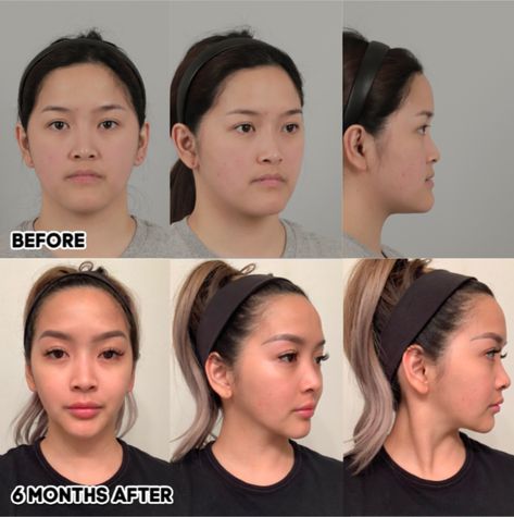 Orthognathic double jaw surgery and natural V line – IDHOSPITAL Double Jaw Surgery Before And After, V Shaped Jaw, Jawline Surgery, Jaw Line Exercise, Korean Nose Job, Korean Nose, Corrective Jaw Surgery, Double Jaw Surgery, V Line Surgery