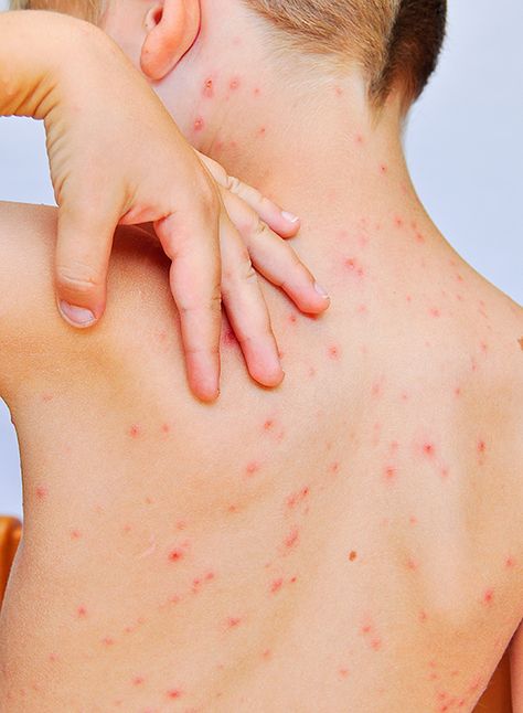 Skin Rashes Pictures, Allergy Rash, Body Rash, Rashes Remedies, Varicose Vein Removal, Stop Hair Breakage, Itchy Rash, Skin Moles, Home Remedies For Skin