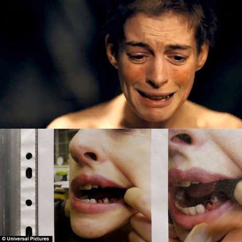 Anne Hathaway won Best Supporting Actress for her role as Fantine in Les Miserables. To play the role, she had to lose weight and even cut her hair, but fortunately the missing teeth was accomplished by painting over her existing teeth. In an interview she said, "I would have pulled out my teeth to play Fantine." Les Miserable, Losing Teeth, Les Miserables 2012, Missing Teeth, Cut Her Hair, Les Miserables, Anne Hathaway, The Missing, She Said