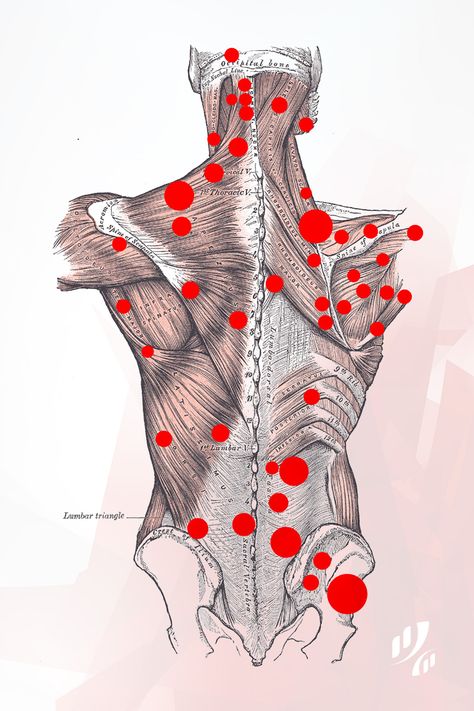 Back Trigger Points. These are common areas where people develop "knots" or hard spots where #muscles get stuck together. By applying pressure and rubbing on these #knots, back and neck muscles can be released and therefore pain is reduced. #TriggerPoint #TriggerPoints  #massage #MassageTherapy Punkty Spustowe, Muscle Knots, Massage Therapy Techniques, Trigger Point Therapy, Reflexology Massage, Trigger Point, Shiatsu Massage, Massage Benefits, Joints Pain Relief