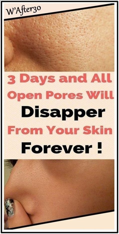 3 Days and All Open Pores Will Disappear From Your Skin Permanently Apple Cider Vinegar For Skin, Organic Aloe Vera Gel, Open Pores, Baking Soda Shampoo, Skin Pores, Enlarged Pores, Skin Toner, Minimize Pores, Healthy Beauty