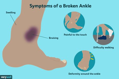 Broken Fibula, Broken Ankle Recovery, Types Of Injuries, Ankle Fracture, Hairline Fracture, Swollen Ankles, Broken Ankle, Ankle Injury, Sprained Ankle