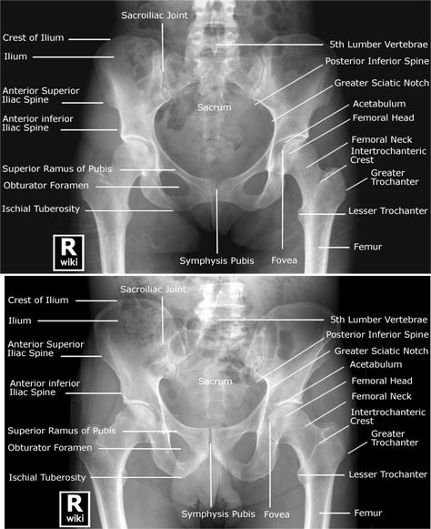 Labeled radiographic anatomy of the male (bottom image) and female (top image) pelvis. Female Pelvis, Pelvis Anatomy, Radiology Schools, Medical Radiography, Radiology Student, Radiology Imaging, Radiology Technologist, Medical School Studying, Nursing School Notes