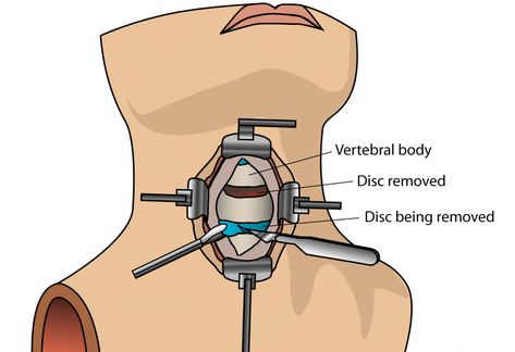 Anterior cervical discectomy (ACDF) surgery: All you need to know Cervical Fusion, Acdf Surgery, Spinal Fusion Surgery, Cervical Disc, Manual Therapy, Cervical Spondylosis, Spinal Fusion, Spinal Surgery, Neck Problems