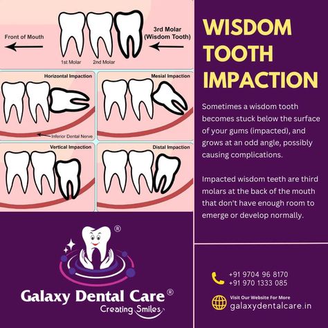 Wisdom tooth impaction is a common dental issue that occurs when a wisdom tooth, which is the last one to grow, doesn't have enough space to emerge or grow normally. Most people have four wisdom teeth and they usually grow through the gums during late teens or early twenties. Impacted wisdom teeth can cause various problems like pain, damage to other teeth, and other complications. Sometimes, impacted wisdom teeth may cause no apparent or immediate problems but are at risk for future issues. Impacted Wisdom Teeth, Wisdom Tooth, Dental Office Design Interiors, Dental Hospital, Dental Office Design, Below The Surface, Wisdom Teeth, Dental Office, Dental Health