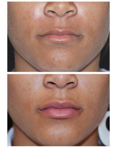 Voluma Cheeks, Juvederm Before And After, Lip Fillers Juvederm, Juvederm Lips, Face Fillers, Botox Before And After, Botox Lips, Botox Cosmetic, Cheek Fillers