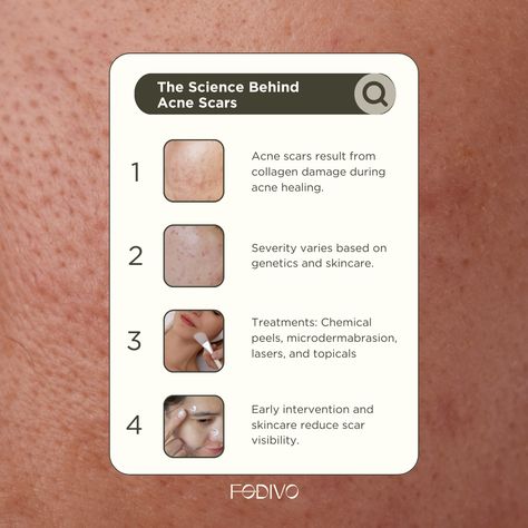 Acne scars result from the body's attempt to heal and repair damaged skin tissue caused by severe or persistent acne 🎯 Skin Infographic, Damaged Skin Repair, Skin Mapping, Skin Facts, Social Media Content Planner, Face Mapping, Dark Spots On Face, Cosmetic Clinic, Nerve Pain Relief