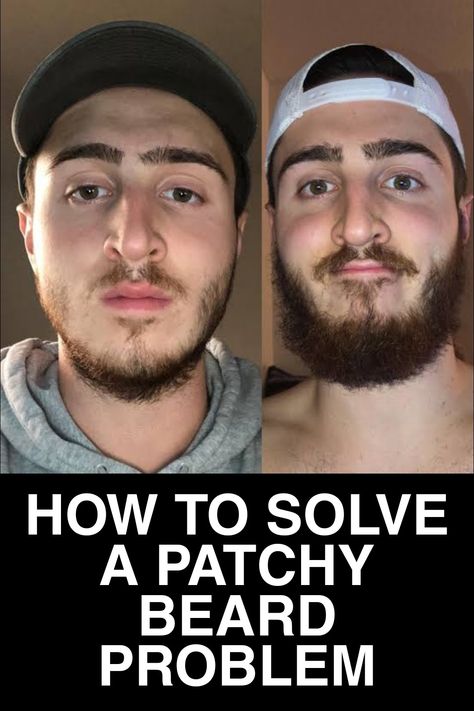 Beard Bald, Patchy Beard Styles, Beard Growth Tips, Beard Styles Bald, Natural Beard Growth, Growing Facial Hair, Diy Beard, Facial Hair Growth, Patchy Beard