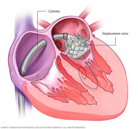 Mitral valve repair and mitral valve replacement - Care at Mayo Clinic - Mayo Clinic Mitral Valve Regurgitation, Prothrombin Time, Cardiac Sonography, Heart Valve, Nurse Teaching, Tricuspid Valve, Mitral Valve, Vascular Surgery, Lung Transplant