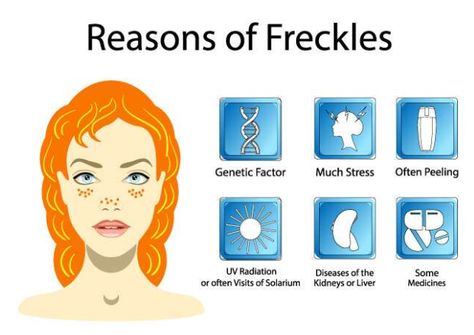 How To Remove Freckles From Face, Remove Freckles From Face, How To Get Freckles Naturally, How To Get Freckles, Getting Rid Of Freckles, Freckle Remover, To Remove Facial Hair, Post Inflammatory Hyperpigmentation, Essential Oil Mixes