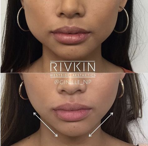 Face Injections, Face Plastic Surgery, Botox Facial, Rhinoplasty Nose Jobs, Face Fillers, Botox Before And After, Face Surgery, Botox Face, Facial Surgery