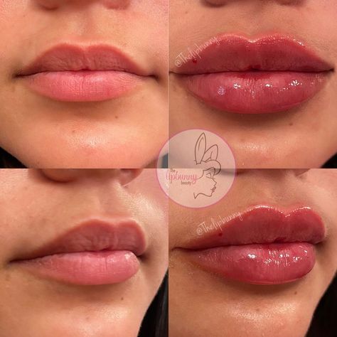 🐰 THE LIP BUNNY ™️ RN, BSN on Instagram: “First time lip fill with @thelipbunny 💉💉 1ML result with #juvederm 👄👄 SWIPE for live results • • #lips #lipinjections #lipgloss #lipfiller…” Lip Fillers Heart Shape, 1ml Lip Filler Small Lips, Jolie Lip Filler, Russian Style Lip Fillers, Lip Fillers On Black Women, Beautiful Lips Aesthetic, Defined Cupids Bow Lip Filler, Slight Lip Filler, 2 Ml Lip Filler