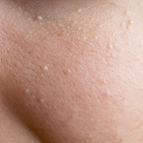 The Ultimate Guide to Bumps or Splotches on Your Face White Bumps On Face, Small Bumps On Face, Holistic Skincare, Remove Skin Tags Naturally, Blind Pimple, Pimples Under The Skin, Skin Bumps, Mole Removal, Skin Disorders