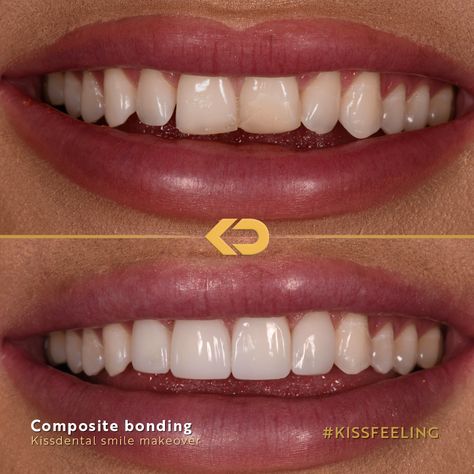 Edge Bonding Teeth, Composite Bonding Before And After, Teeth Bonding Before And After, Composite Bonding Teeth, Teeth Makeover, Teeth Bonding, Composite Bonding, Misaligned Teeth, Composite Veneers