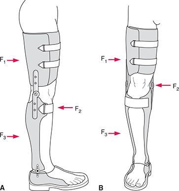 KAFO full leg brace no drop lock Kafo Leg Braces, Leg Exoskeleton, Exoskeleton Suit, Medical Tech, Knee Support Braces, Daily Life Hacks, Diy Props, Futuristic Armour, Prosthetic Leg